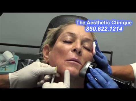 Radiesse Questions Answered by Dr. Steven F. Weiner, Facial .